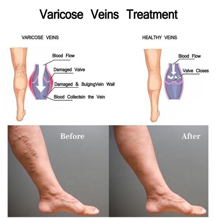 20g-Varicose-Veins-Removal-Varicose-Veins-Treatment-Cream-Ointment-Vasculitis-Inflammation-Chinese-Herbal-Leg-Massage-Plaster_4773c243-f783-4d57-a43c-1469bf11cabe_720x